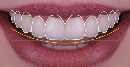 2026 Gulus Tasarimi Fiyatlari Hollywood Smile Ne Kadar
