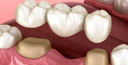 2026 Kopru Dis Fiyatlari Kopru Dis Tedavisi Kopru Turleri