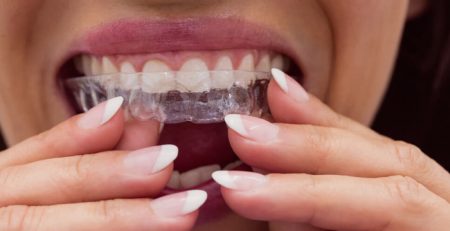 2026 Seffaf Plak Invisalign Fiyatlari Melsadent