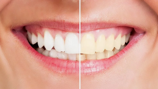 Dis Beyazlatma Bleaching 1