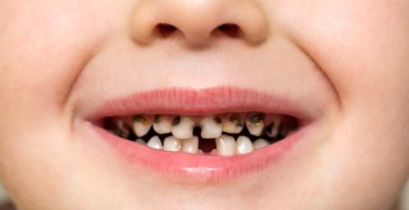 Dis Curukleri Nasil Onlenir Yeni Nesil Koruyucu Yontemler ve Florur Uygulamalari