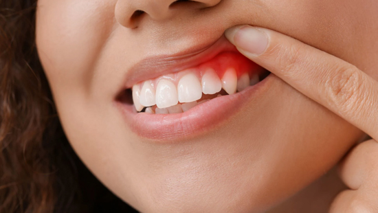 Dis Eti Tedavisi Periodontoloji