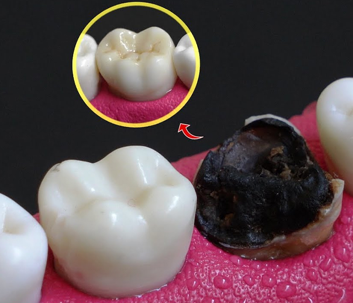Diş Kaplama Altında Ağrı Neden Olur? Zirkonyum Diş Ağrısı Diş Kaplama Altında Ağrı Neden Olur Zirkonyum Diş Ağrısı
