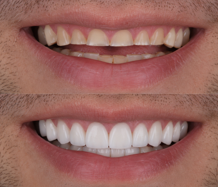 How to Treat Shortened Teeth Due to Teeth Clenching/Grinding? How to Treat Shortened Teeth Due to Teeth Clenching/Grinding