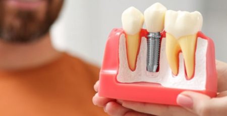 En Ucuz Implant Fiyatlari 2026 Istanbul Turkiye