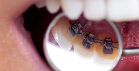Gizli Dis Teli Lingual Ortodonti 2026 Fiyatlari