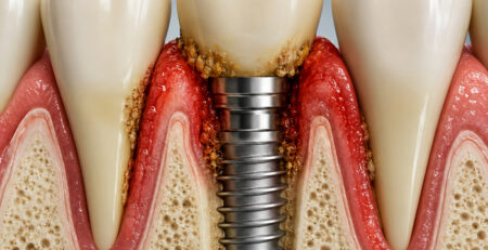 Implant Cevresi Iltihabi Periimplantitis Nasil Baslar