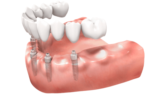 Implant Tedavisi - Melsadent Implant Tedavisi Melsadent