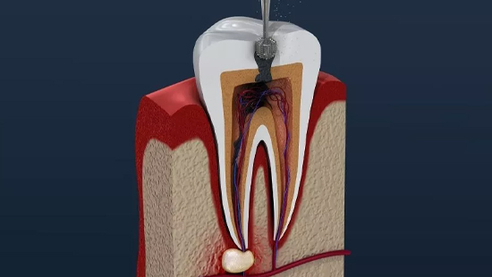 Kanal Tedavisi Endodonti
