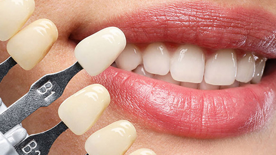 Laminate Veneer Dis Kaplama