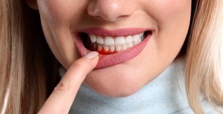 Sessiz Ilerleyen Tehlike Periodontitis ve Erken Teshis Onemi