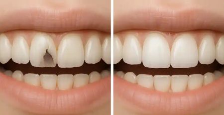 Tek Dis Kaplama Fiyati 2026 Guncel Rehber ve Detaylar