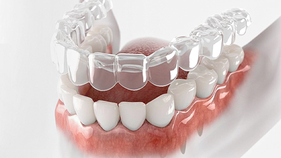 Telsiz Ortodonti (Invisalign) Telsiz Ortodonti Invisalign
