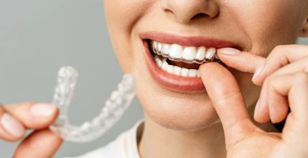 Faydalı Bilgiler Telsiz Ortodonti Seffaf Plak Nedir Avantajlari ve Tedavi Sureci