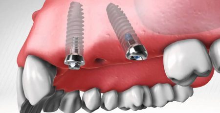 Faydalı Bilgiler Zigoma implant Yetersiz Kemikte Sabit Cozum