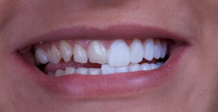 Zirkonyum Kaplama mi Emax mi Hangisi Daha Iyi