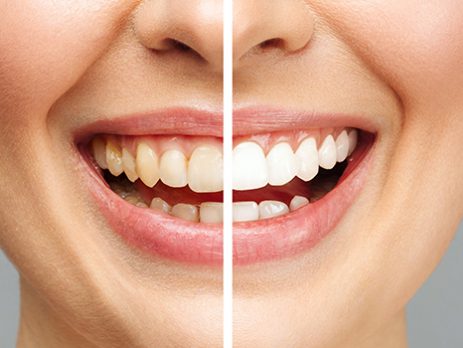 Teeth whitening in Tuzla